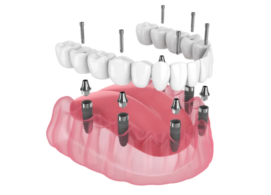 All-on-4 / All-on-6 : le cabinet dentaire La Bastide à L'Isle-sur-la-Sorgue