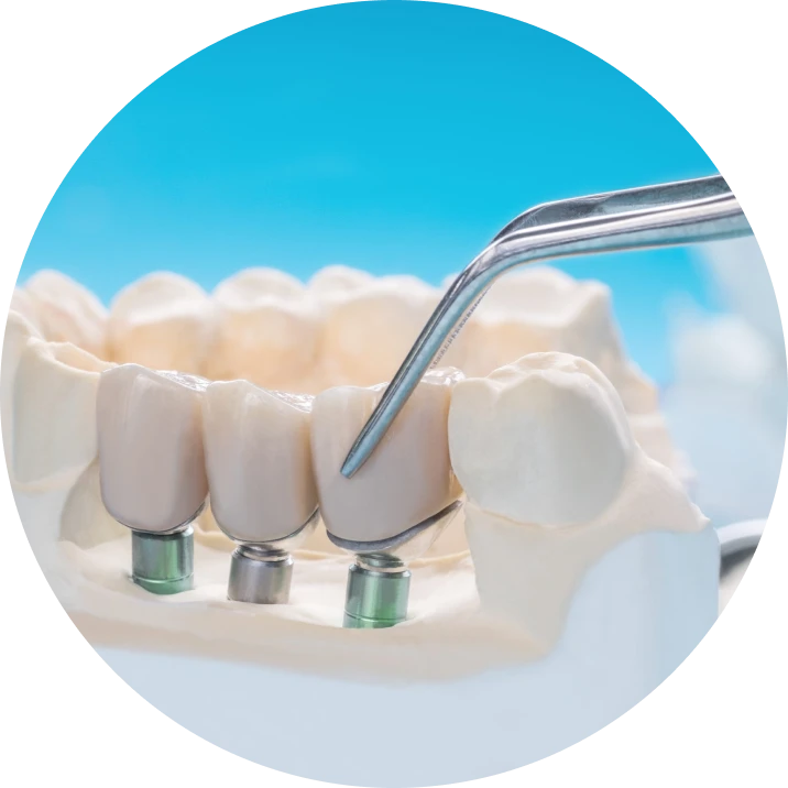 Implantologie : traitements au cabinet dentaire La Bastide à L'Isle-sur-la-Sorgue