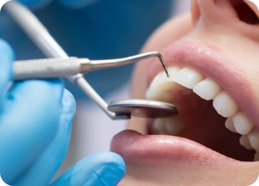 Composite stratifié au cabinet dentaire La Bastide à L'Isle-sur-la-Sorgue