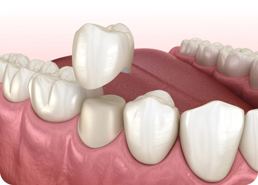 Couronnes dentaires au cabinet dentaire La Bastide à L'Isle-sur-la-Sorgue