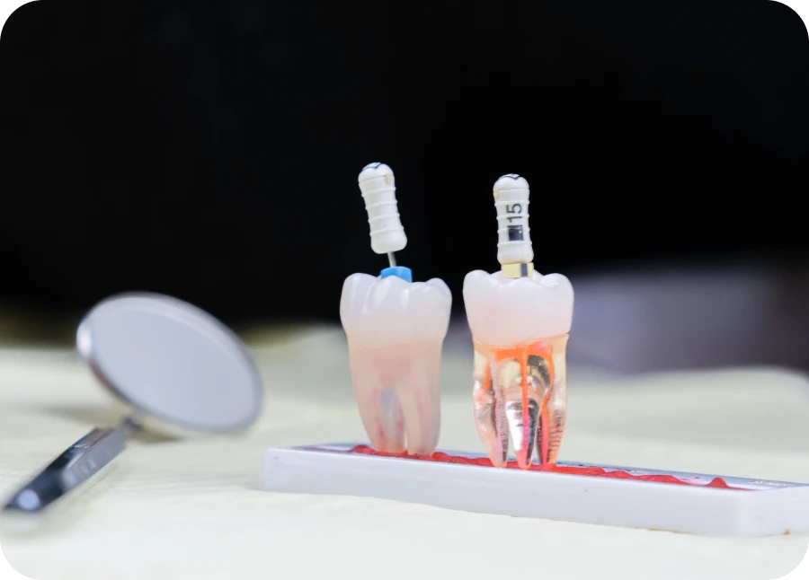 Endodontie au cabinet dentaire La Bastide à L'Isle-sur-la-Sorgue