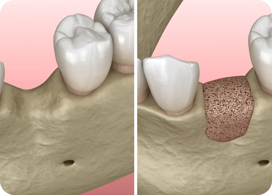 Greffe osseuse au cabinet dentaire La Bastide à L'Isle-sur-la-Sorgue